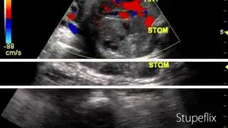 Ultrasound video of CDH or congenital diaphragmatic hernia- left sided