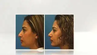 Top Rhinoplasty Surgeons in Arizona -  Rhinoplasty Society
