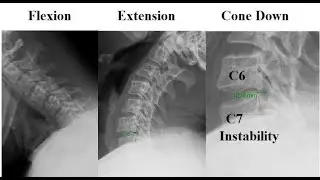 Cervical spine instability; ligaments and supporting structures of neck fail to maintain Alignment