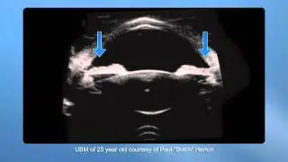 Goldberg UBM file in motion during accommodation - Supplementary video: 25983