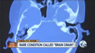 Rare condition called the Brain Drain