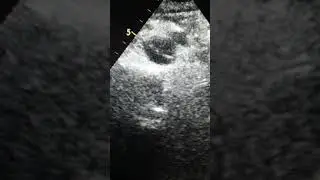 Aortic dissection - Abdominal aorta with intimal flap