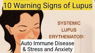 10 Warning Signs of Lupus: Auto Immune Disease & Stress and Anxiety #SLE #lupus #symptoms #signs