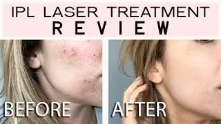 IPL LASER TREATMENT Reivew