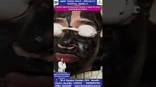 Carbon peel Hollywood facial treat hyperpigmentation, post-acne pigmentation or skin rejuvenation