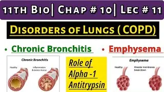 Disorders of Lungs || COPD & it's Types || Chronic Bronchitis| Emphysema| 11th Bio| Ch # 6| Lec # 11