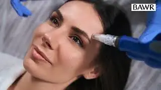 Microneedling in Dallas, TX: Complete Treatment & Aftercare