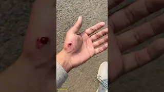 Day 81 of kicking Moolchand jee, No pain, No Gain #viral