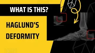 Haglund's deformity?? Check this out!