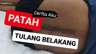 Patah Tulang Belakang Tulang Ekor Tulang Sakrum | Cerita Horor
