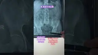 X Ray KUB ,  Urinary Bladder stone #stone #kidneystone