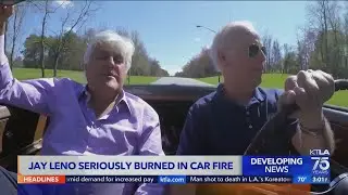 Jay Leno suffers serious burns in fire
