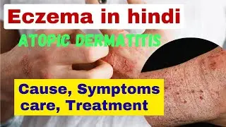 eczema kya hota hai | atopic dermatitis in hindi | skin problem | eczema treatment