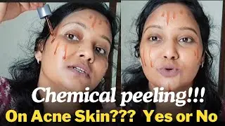 Chemical Peeling at home for acne #acneproneskin acne #chemicalpeeling #skincare