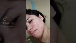 BELO ACNE PRO journey #beloacnepro #skincare #beauty