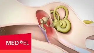 Qu&rsquo;est-ce que la surdit&eacute; de transmission | MED-EL