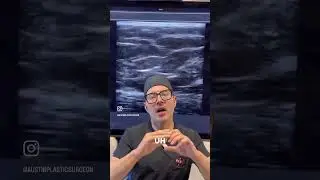 🍑✨ BBL Safety with Ultrasound Guidance