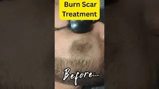 Burn Scar  Treatment | Before & After   #drvipulpareek