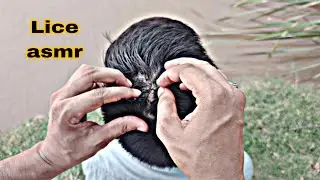 How to Remove Black Lice Easily at Home | Lice Treatment & Prevention Tips