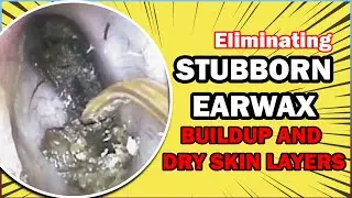 Breaking Down | Huge Hardened earwax and dry skin in the ear - earwax removal - Dr Steven 35