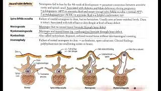 Neural Tube Defects Explained (In Hindi Podcast) #medicalpodcast #neuraltubedefects #spinabifida