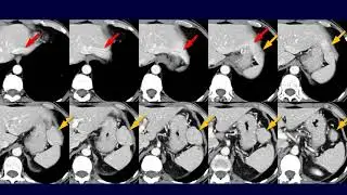 Hypervascular exophytic mass in non-cirrhotic liver - DDx FNH, angiomyolipoma, HCC, inflammatory HCA