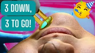3RD SESSION OF FACE LASER HAIR REMOVAL
