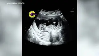 What Happens When Mother Laughs During Ultrasound