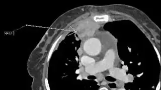 CECT CHEST FINDING WITH ANOTATION. Subscribe for more videos. #radiology  #viralvideo #madical