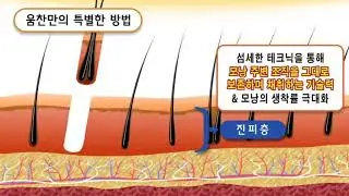 움찬 비절개 모발이식 woomchan  FUE - One Touch Technique 원터치테크닉 소개