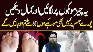 Warts Treatment In Urdu | Mason Ka Ilaj | Mason Ka Ilaj |Skin Problem | Dr Sharafat Ali