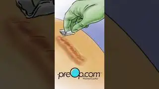 PreOp&reg; 🤕 Best Practices in Wound Care #preop #shorts #health 🛡️