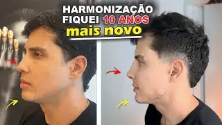 HARMONIZAÇÃO FACIAL (Antes e depois) mandíbula, nariz e queixo (Falei quanto custa)