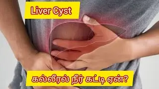 Liver cyst.கல்லீரல் நீர் கட்டி. Homoeopathy Treatment 
