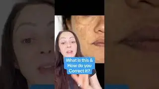What is this & how do you correct it?!#melasma