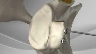 Latarjet Procedure