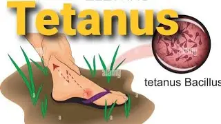 Tetanus | lock jaw | Clostridium tetani infection