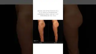 Brazilian Butt Lift - Before and After