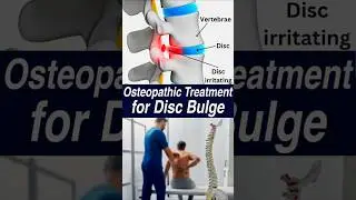 Osteopathic Treatment for Disc Bulge | Relieve Back Pain Naturally | Manual Therapy Explained