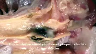 The Oxidized Cholesterol Strategy,What is Oxidized LDL Cholesterol?