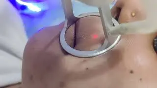 Tired of Open pores, scar, sagging of skin, stretch marks, spots- one treatment Co2 laser 
