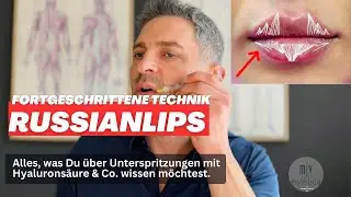 Russian Lips: Lippenunterspritzung mir Hyaluron.