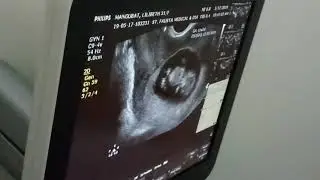 Baby swimming and jumping inside mother's womb.