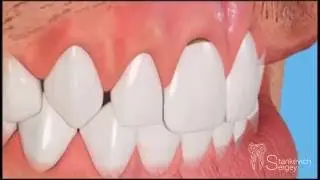 What is a clinoid defect of the hard tooth tissue?