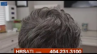 PRP for Male Pattern Baldness - Platelet Rich Plasma Treatment