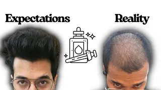 Using Minoxidil but not getting results ? Do this