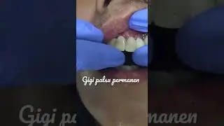 Gigi Palsu Permanen | Dental Bridge | Jembatan | Dokter Riesqi