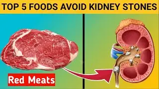 Top Foods to Avoid for Kidney Stone Prevention | Kidney Health Tips || kidney failure || Health AR