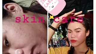 SOLUSYON SA PIMPLES AND SCARS? (UPDATED SKIN CARE ROUTINE!)