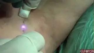 Phlebology | Reticular & Telangectasias - LASEmaR&reg;800 [Eufoton&reg;]